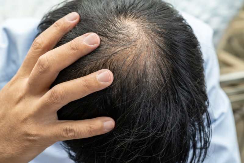 Merawat Rambut Rontok dengan Benar: Panduan Lengkap Mengatasi Kerontokan, Menjaga Kekuatan Akar Rambut, dan Meningkatkan Keindahan Rambut Alami